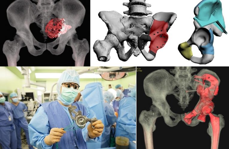 골종양 환자 3D프린팅으로 뼈 재건