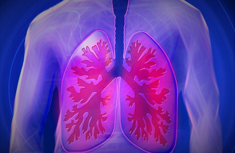전세계 사망 원인 1위 예상되는 만성폐쇄성폐질환(COPD)은?